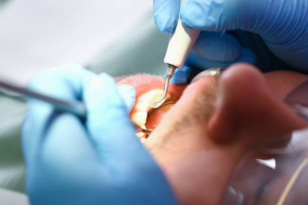 Best Emergency Wisdom Teeth Removal in Edgemont Park, MI